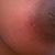 Breast scar - 4 months
