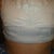 One day post-op