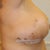 Post op day 12