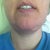 11 Weeks Post Op. Here you can see my chin puckers that are on either side of my incision. REALLY hoping these go away when the swelling in that area is gone.