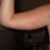 POD 9  Right Arm Front