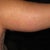 POD 9 Right Arm Back