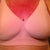 Day 18 Post Op.