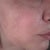 one side is not as burned as the other side of my face