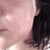 burned side, you can see the spot on my high cheak bone where it is beginning to peel prematurely.It might leave a scar. I scratched during the night unintentionally.  