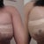 day 1 and day 2 post op