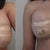 day 1 and day 2 post op