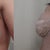 day 1 and 2 post op