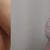 day 1 and day 2 post op