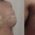 day 1 and day 2 post op