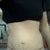 Day 13-Looking MORE bloated :( Might be cause I started my period this morning AND I've been eating more normaly. Scar is starting to scab over tho
