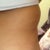 Left hip flat