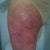 After 20 hours, pretty typical bruising for me. You can see the little incision, shallow,  no stitches.  Not painful, just colorful.