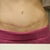 One year post op!