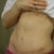 One year post op!