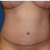 14 weeks post-op