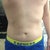 4 months post-op