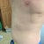 4 months post-op