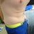 4 months post-op slightly bent over
