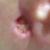 infected hole in front of left ear (after three rounds of antibiotics)