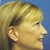 Less waddle but no ear lobes- cannnot wear earring because the piercing is no longer facing forward.