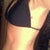Side view bikini shot 10 days pre-op