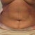 after revision upper abd lipo (11 weeks post TT)