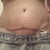 PO day 9, swelling down a bit