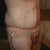 2nd Day Post-Op, side view. Drains still intact. Male extended abdominoplasty with lipo of the suprapubic and epigastric area.