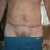 2 weeks Post-Op, front view. Male extended abdominoplasty with lipo of the suprapubic and epigastric area.