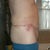 2 weeks Post-Op, side view. Male extended abdominoplasty with lipo of the suprapubic and epigastric area.