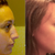 Before compared to 3 weeks post surgery