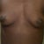 Front view: Before Surgery