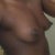 Side view: Before Surgery