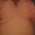 Six weeks. Picture bit dark but shows lollipop scar as apose to anchor/T scar.