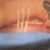 scar tear-day 2-right side