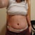 5 days post op (front)