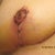 closer look at nipple and t incision on left breast