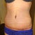 Post Op week 5 not much changed.