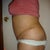 3 weeks 2 days post left
Really swollen... Was really ACTIVE today
Got My Period today so I could also be Bloated
