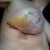 Some bruising from the capsulectomy I assume. Not painful and taking lots of arnica to help the healing.