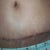 a close up of scar at 20 days