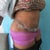 bruising from the lipo