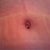 PO day 19. Close up of bb. Just a little area of scabbing left.