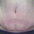 5 Weeks PO Front with Scar