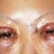Day after surgery.  Eyes nearly swollen shut, undereye area swollen from fat removal and transfer through inner lid, undereye skin has been lasered to tighten