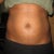 Day 1-After procedure (swollen)