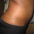 Day 1- After Procedure Side (swollen)