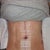 "After" - 1 day post op