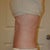 "After" - 4 days post op